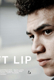 Cleft Lip
