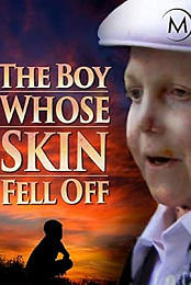 The Boy Whose Skin Fell Off
